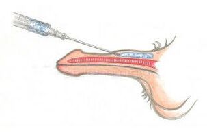 Hialuronskābes injicēšana zem ādas, lai padarītu dzimumlocekli biezāku