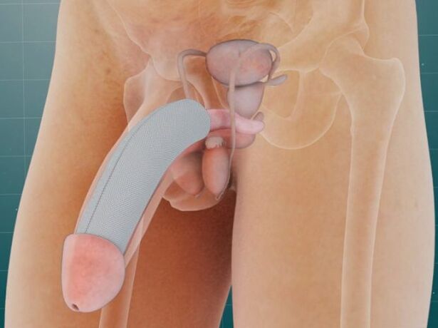 Dzimumloceklis pēc īpaša implanta ieviešanas zem ādas