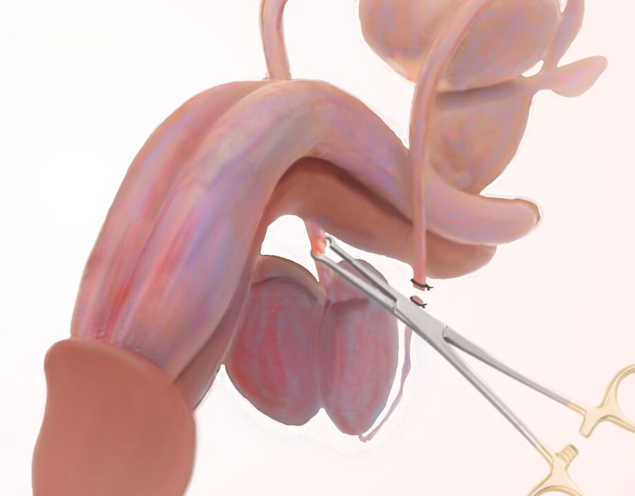 ligamentotomija dzimumlocekļa paplašināšanai